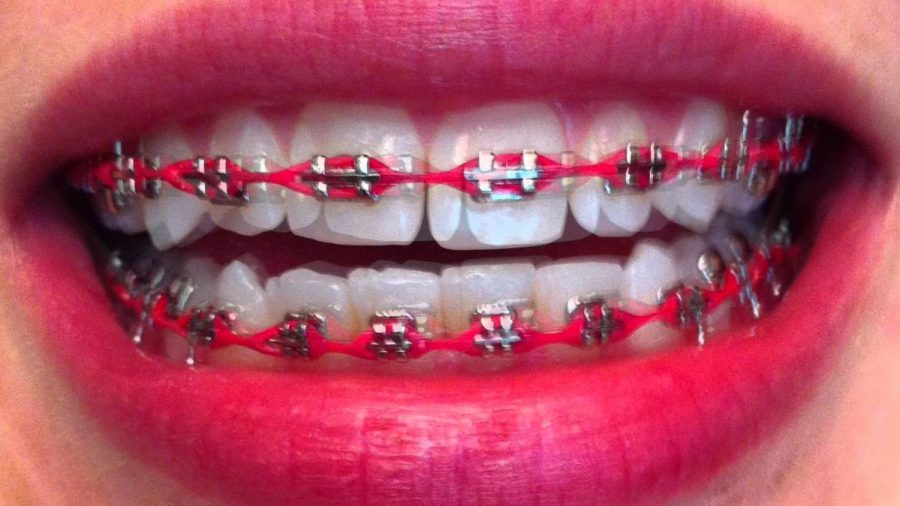 Pros and Cons of getting braces