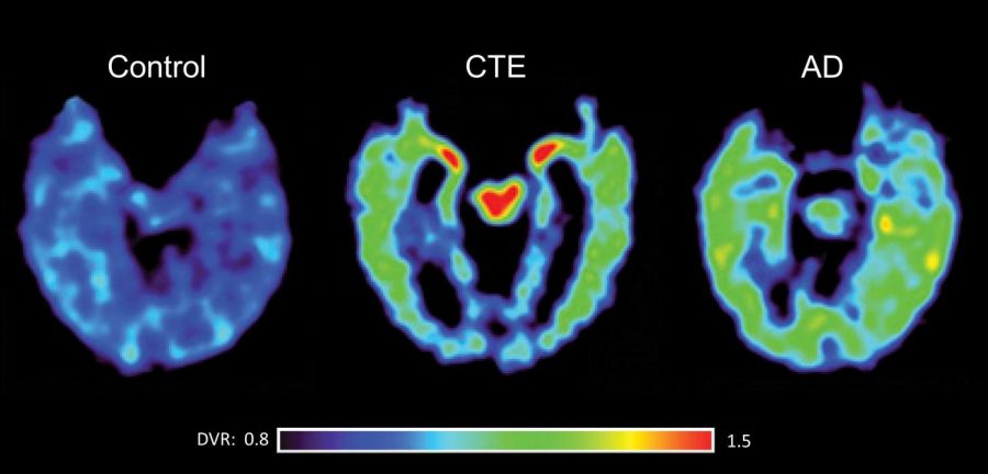 What are the effects of contact sports on mental health?